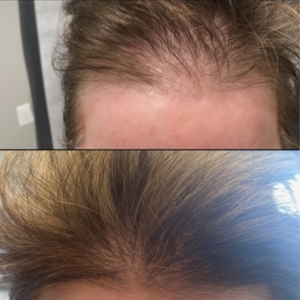 Hair Restoration PRP Treatments and Topicals