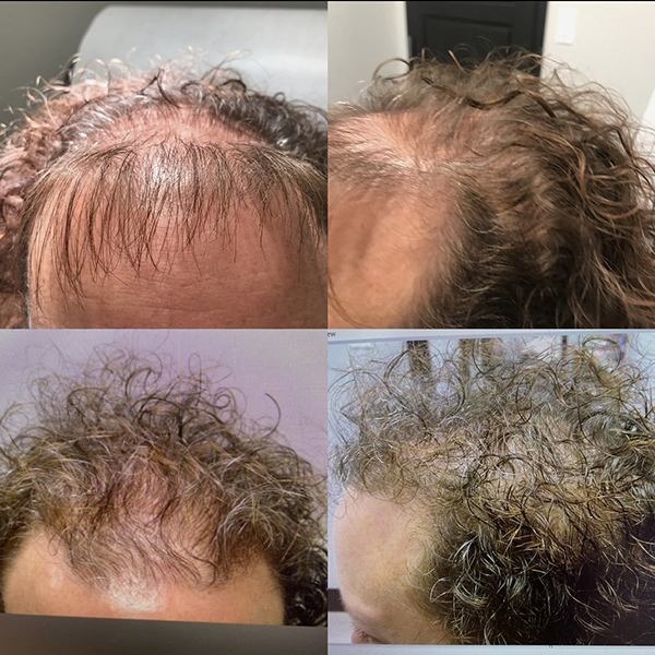 Hair Restoration Treatments Before and After
